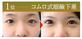 コムロ式眼瞼下垂治療