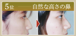 自然な高さの鼻